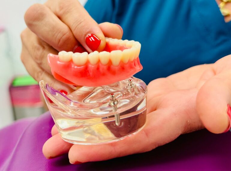 Implantologia dentale a roma