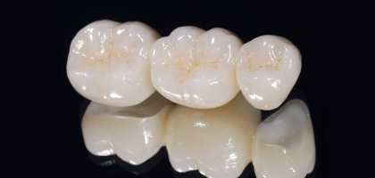 Corone Dentali