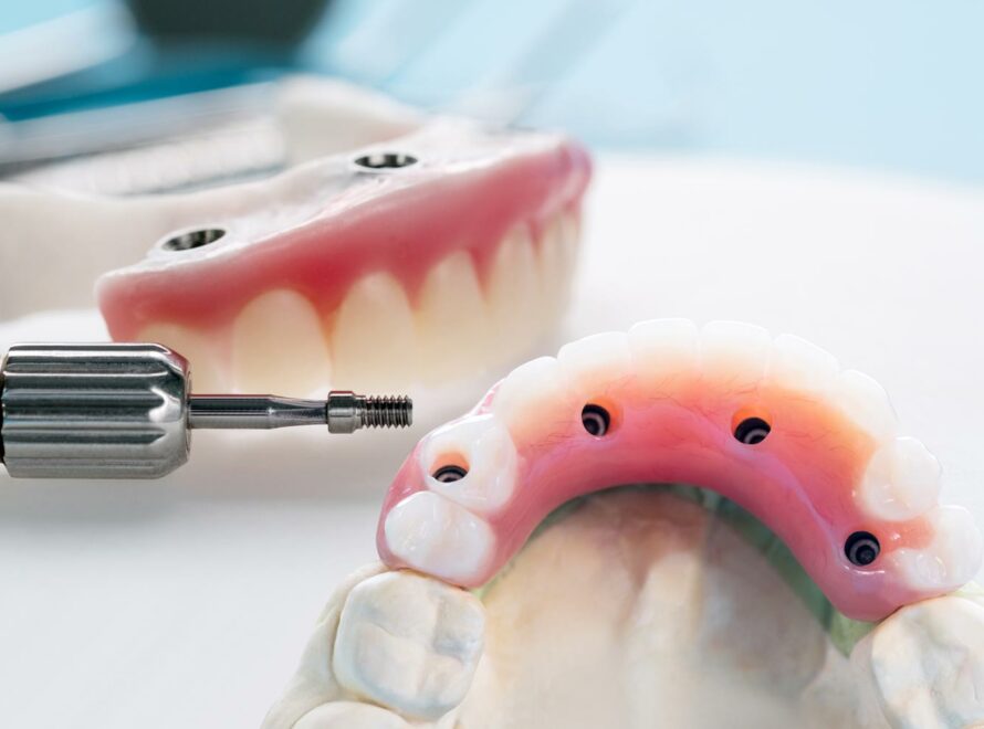 Impianti Overdenture a Roma