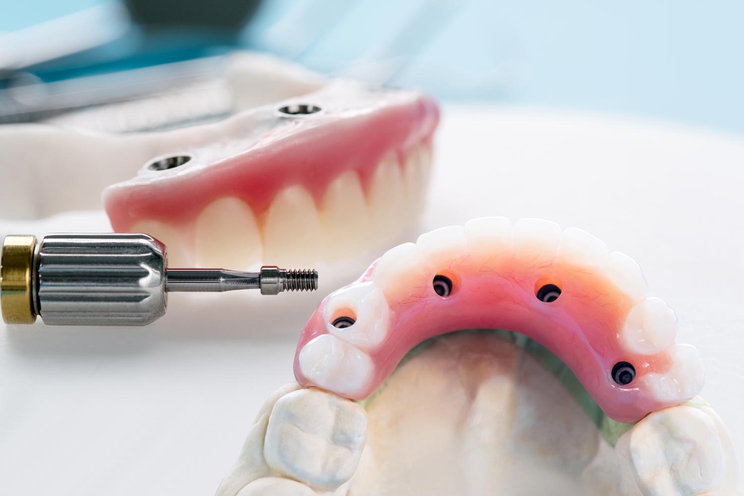 Impianti Overdenture a Roma