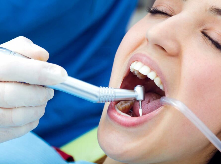 Pulizia dei Denti o Ablazione del Tartaro