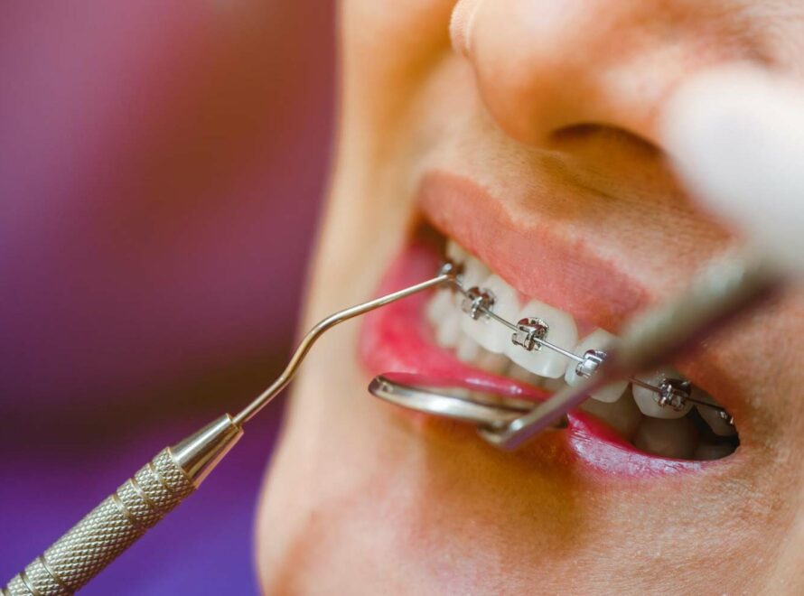 apparecchio denti roma