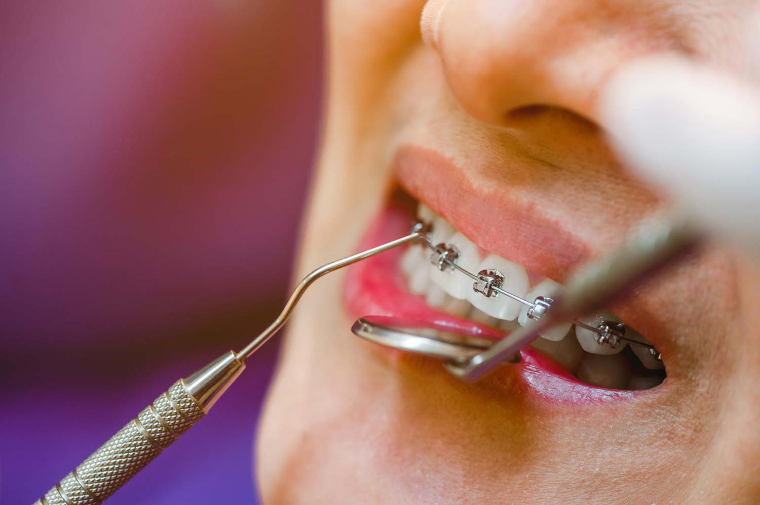 apparecchio denti roma