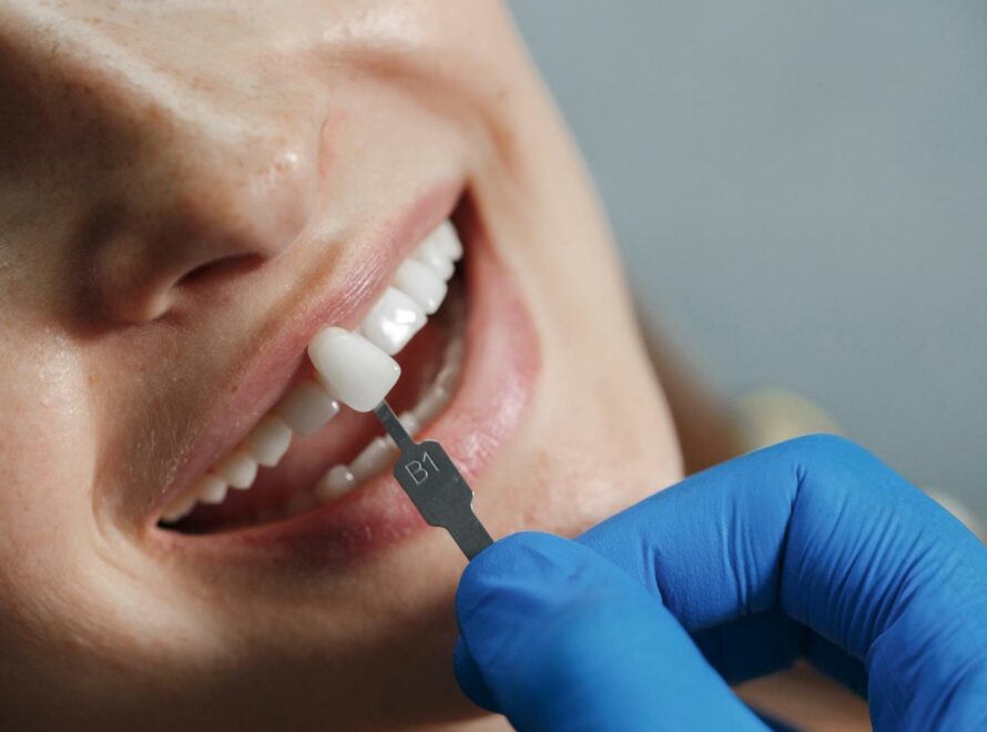 faccette-dentali-a-roma
