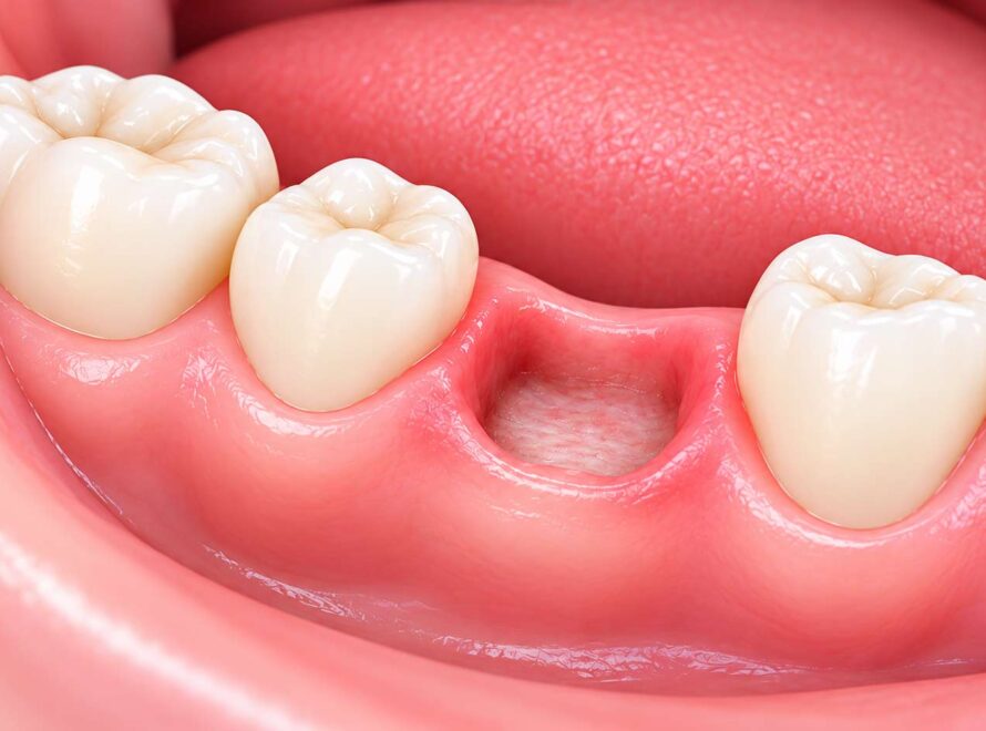 alveolite post estrattiva