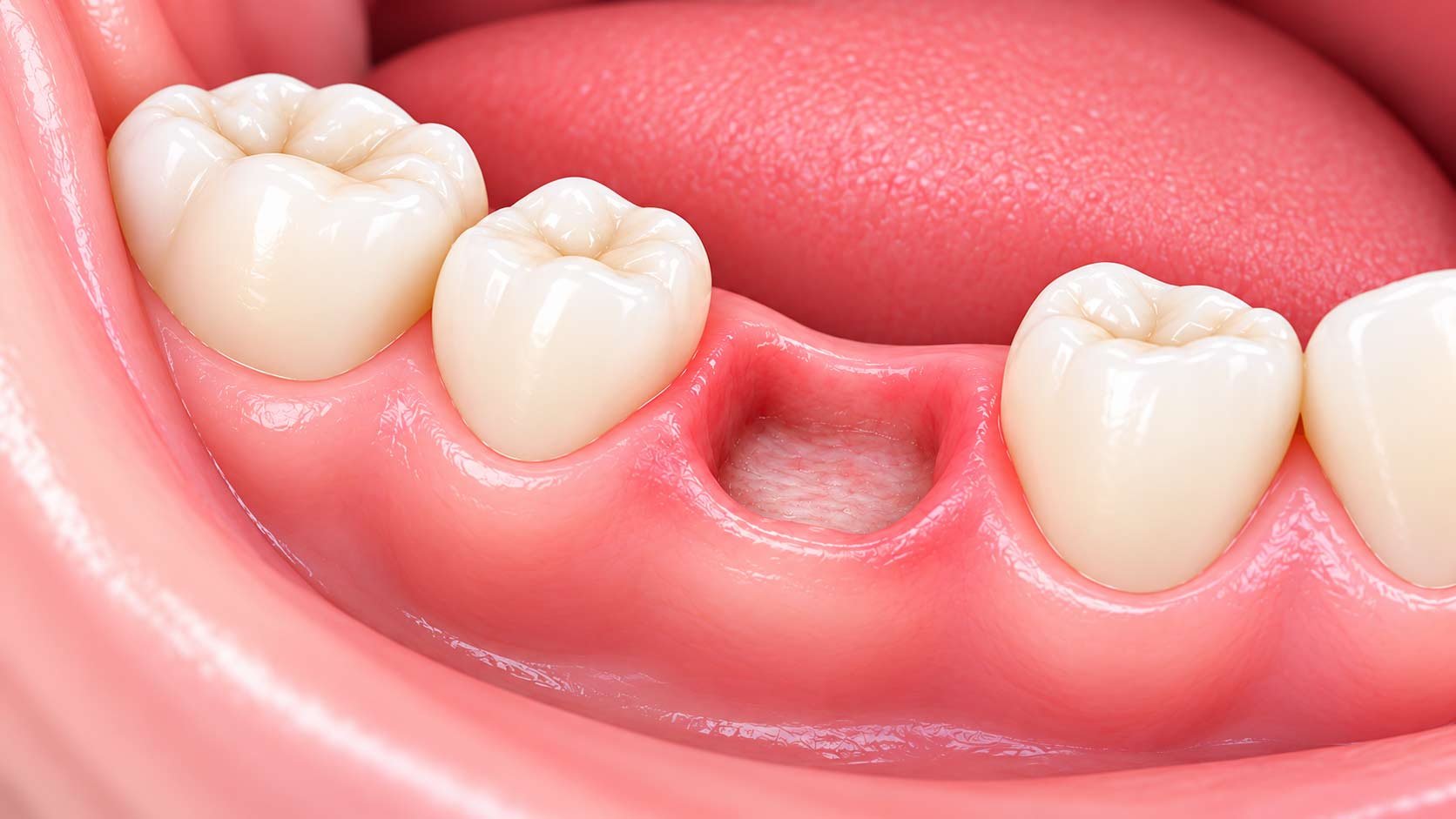 alveolite post estrattiva
