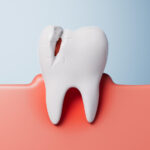 dente incrinato