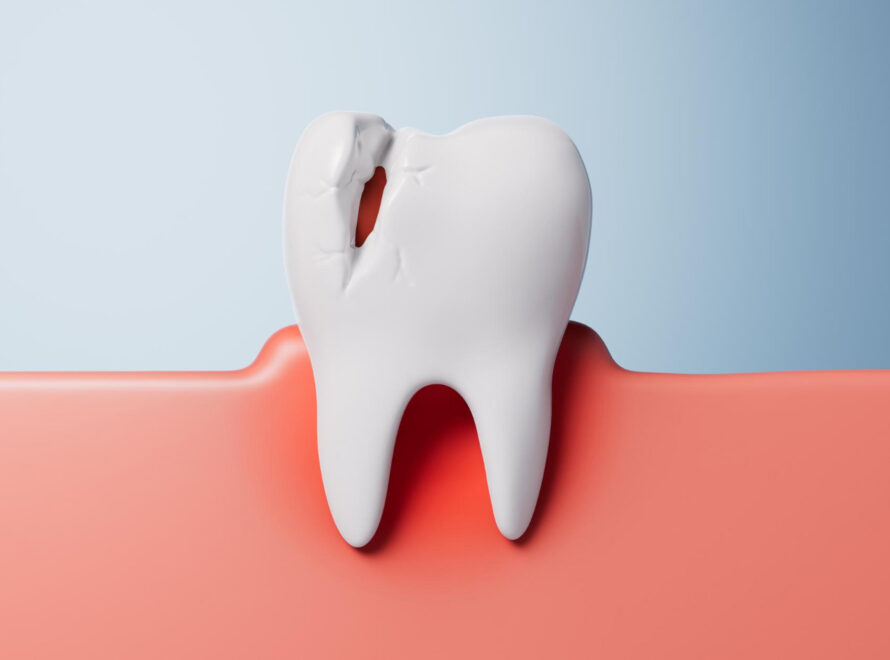 dente incrinato