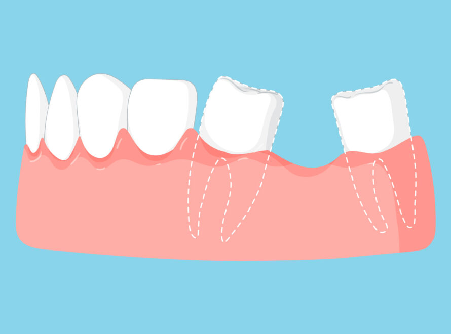 agenesia dentale negli adulti