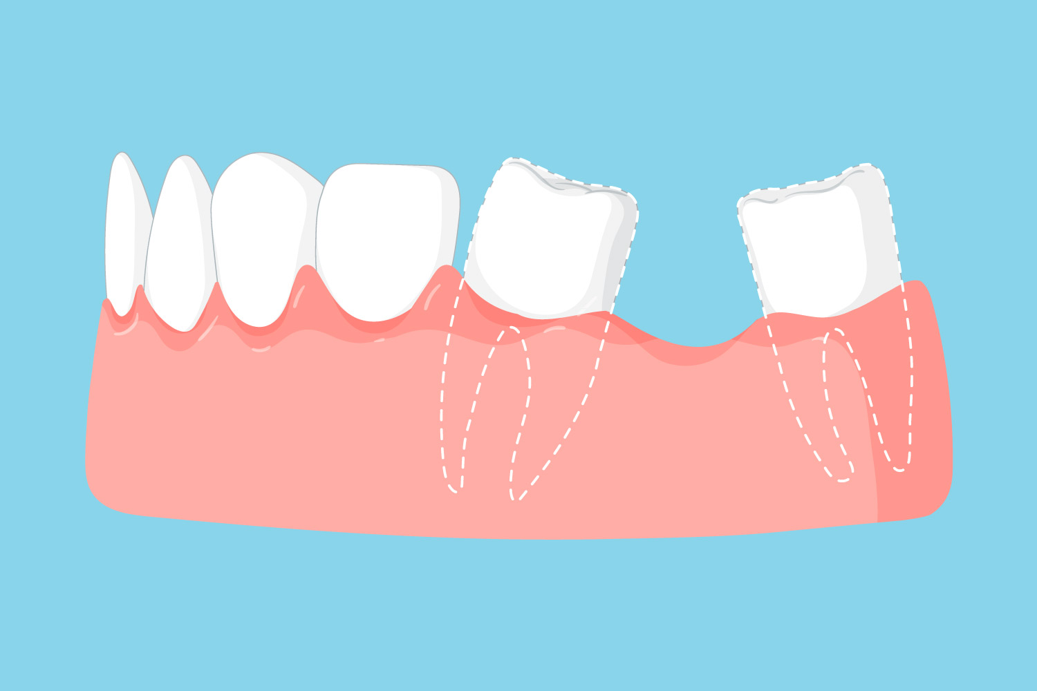agenesia dentale negli adulti