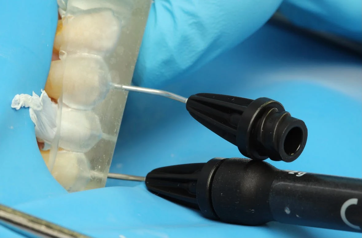 Applicazione del composito durante la Injection Technique
