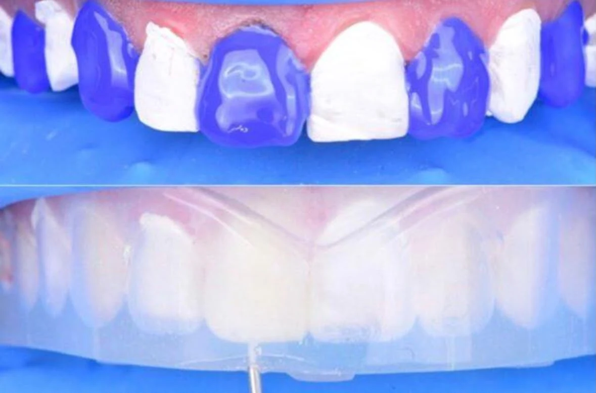 Modellazione estetica dei denti con Injection Technique