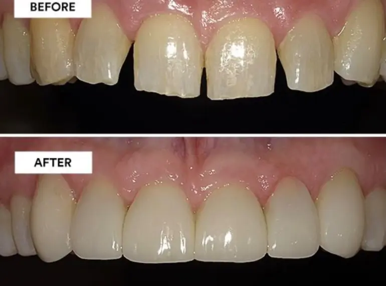 Prima e dopo di ricostruzione estetica dei denti con Injection Technique