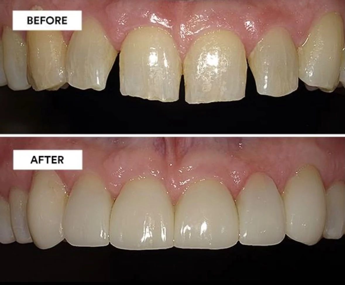 Injection Technique prima e dopo, esempio clinico di ricostruzione estetica dei denti