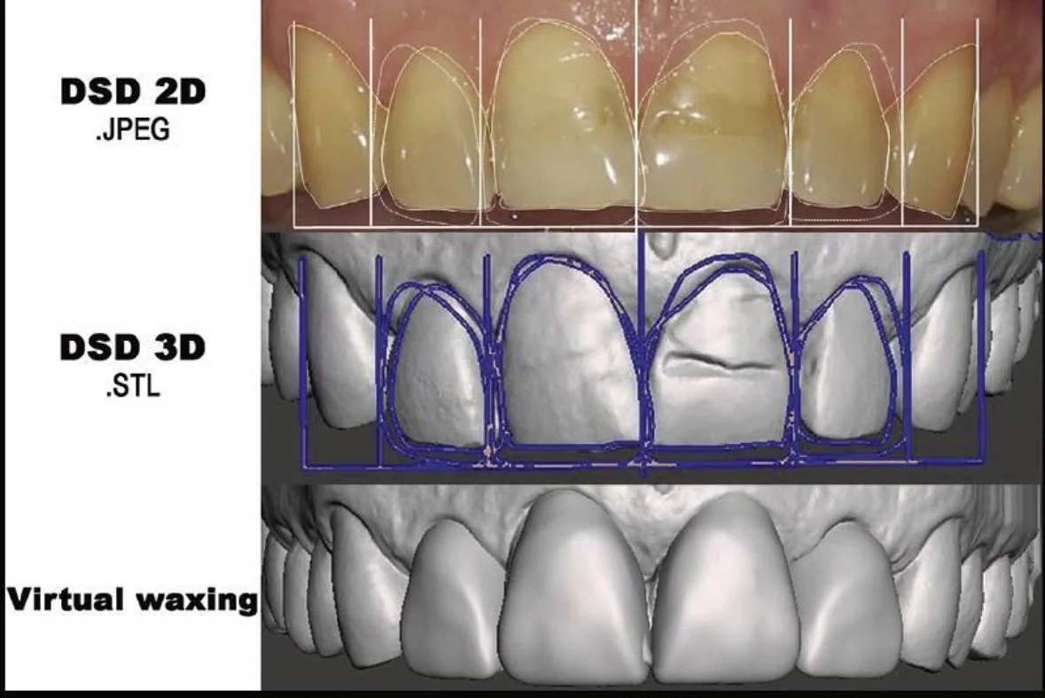 Progettazione digitale del sorriso per Injection Technique